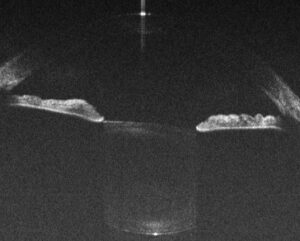 Anterior Chamber, Cobra-S 800 nm OCT